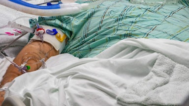 A patient's arm is seen with tubes attached.