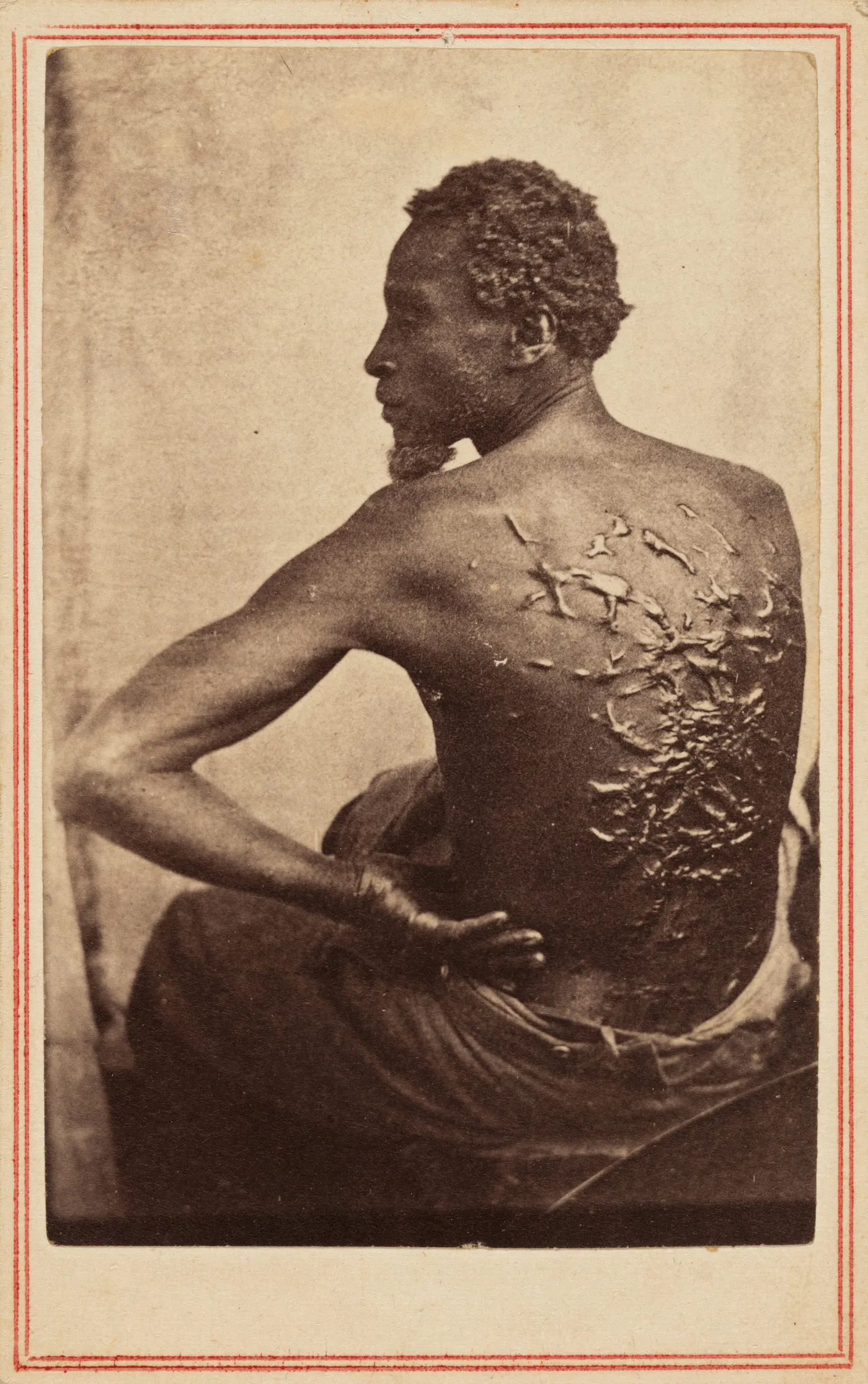 A formerly enslaved man displays his bare back, covered in scars from repeated whippings, in a portrait taken in Louisiana, c. 1863.