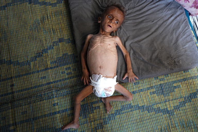Mohammed Zakaria al-Mutawaq, a 1.5-year-old Palestinian boy suffering from severe malnutrition, lying on a mattress. His bones are visible because he is so emaciated.