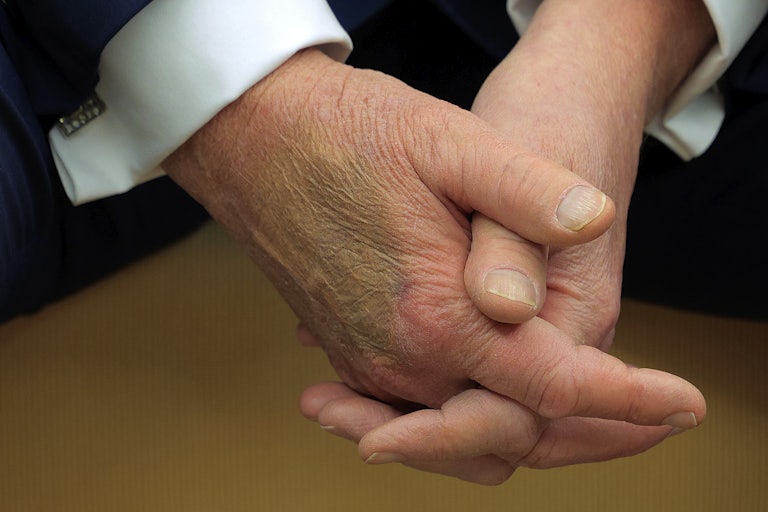 Donald Trump clasps his hands. His right hand has a giant bruise on the back.