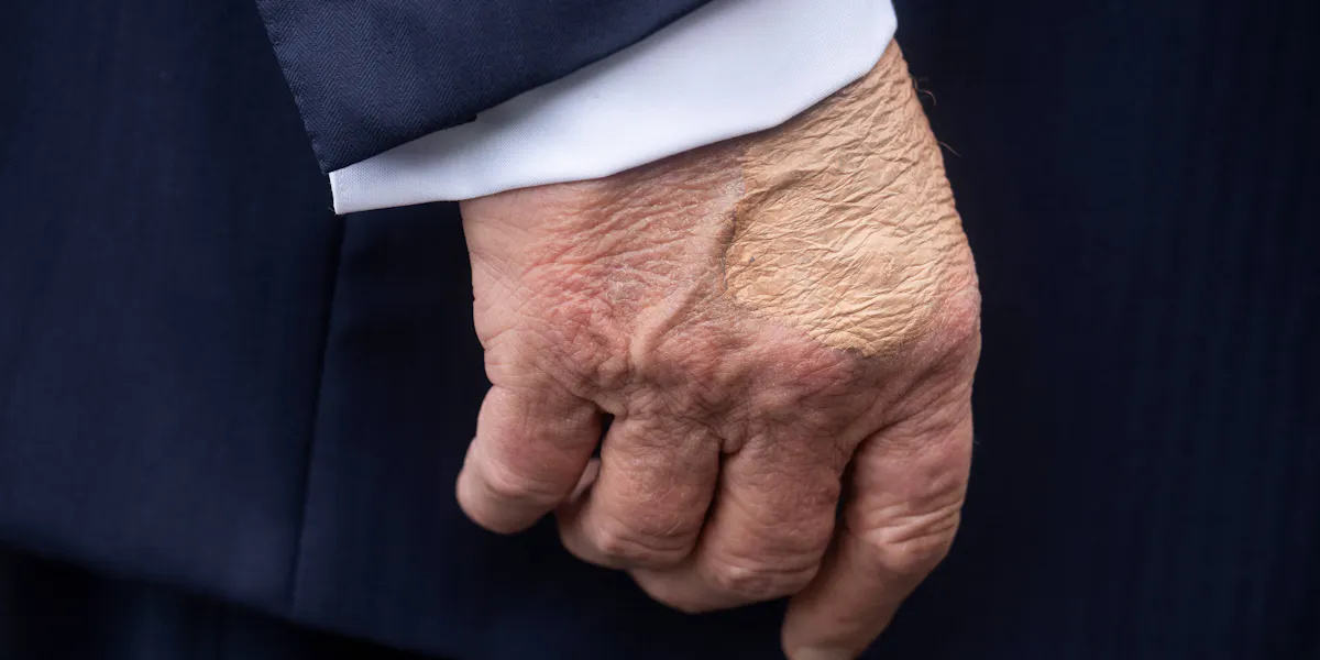 WTF Is Going on With Trump's Hand?