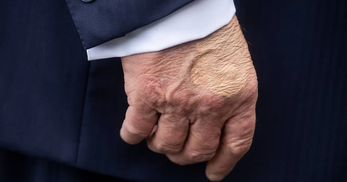 WTF Is Going on With Trump’s Hand?