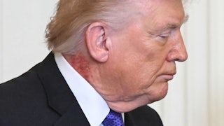 Donald Trump looks to the side. A mysterious, scabbed rash is visible on the side of his neck.