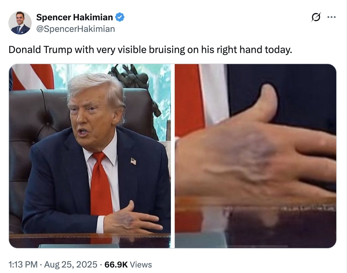 X screenshot Spencer Hakimian @SpencerHakimian Donald Trump with very visible bruising on his right hand today. (photos of his bruised hand)